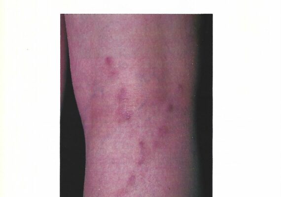 Cicatrices-cheloïdes-de-phlébectomies-Phlebologie-Phlebologie-1998-51-513-14-pdf